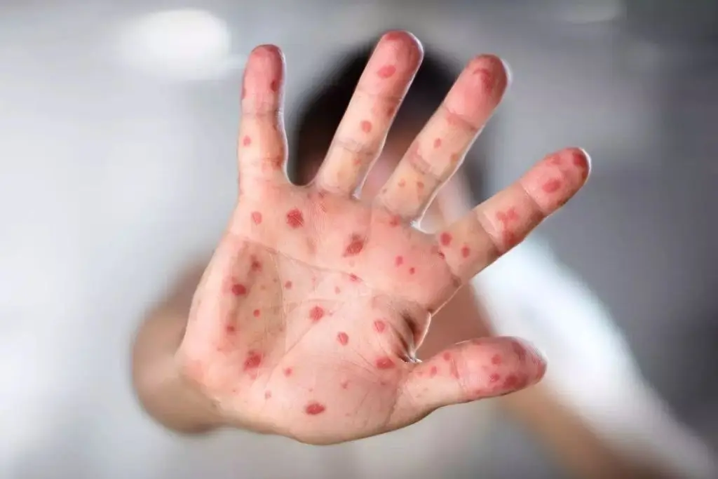 Primer caso importado de sarampión en México; menor se encuentra estable