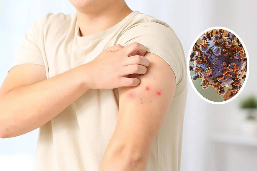 México detecta su primer caso de viruela símica en paciente alemán 