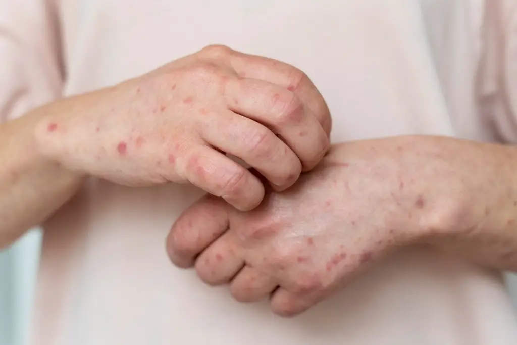 México confirma su primera muerte por sarampión en 2026