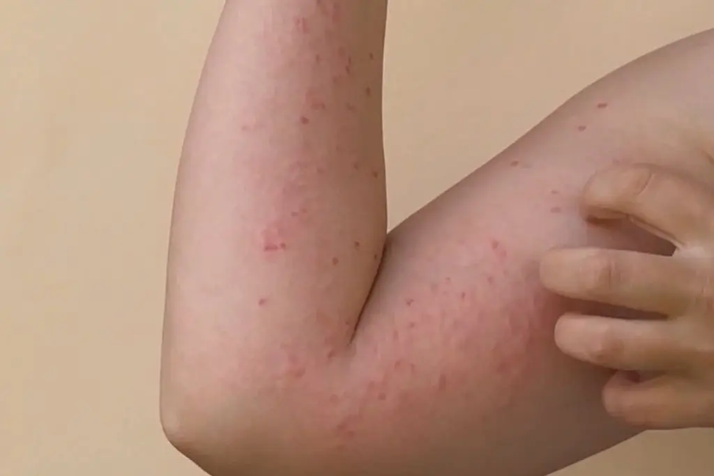 Sarampión repunta en México: superan los 16 mil casos y continúa la propagación